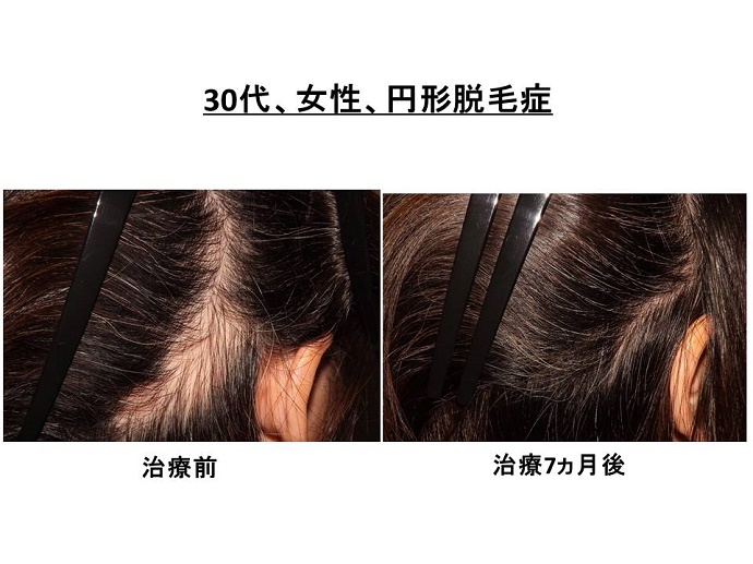 円形脱毛症　病院""